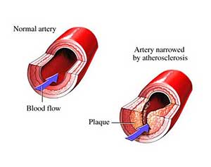 Coronary Artery Disease - Dr. VT Shah